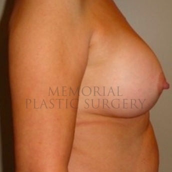 A side view after photo of patient 178 that underwent Breast Augmentation procedures at Memorial Plastic Surgery