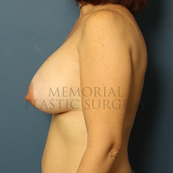 A side view after photo of patient 455 that underwent Breast Augmentation procedures at Memorial Plastic Surgery