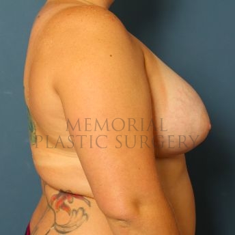 A side view after photo of patient 148 that underwent Breast Augmentation procedures at Memorial Plastic Surgery