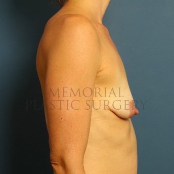 A side view before photo of patient 85 that underwent Breast Augmentation procedures at Memorial Plastic Surgery