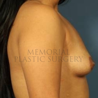 A side view before photo of patient 204 that underwent Breast Augmentation procedures at Memorial Plastic Surgery