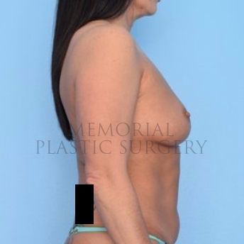 A side view before photo of patient 707 that underwent Breast Augmentation procedures at Memorial Plastic Surgery