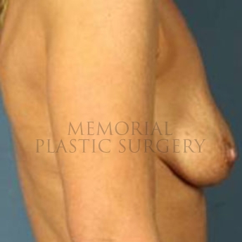 A side view before photo of patient 177 that underwent Breast Augmentation procedures at Memorial Plastic Surgery