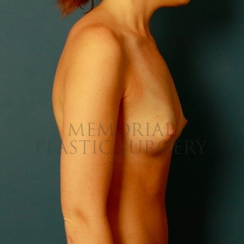A side view before photo of patient 92 that underwent Breast Augmentation procedures at Memorial Plastic Surgery