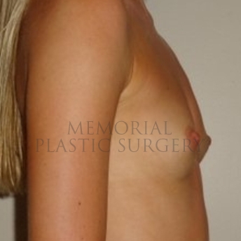 A side view before photo of patient 203 that underwent Breast Augmentation procedures at Memorial Plastic Surgery