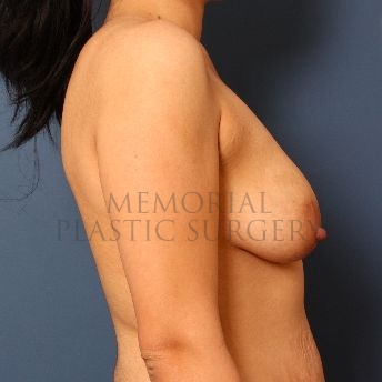 A side view before photo of patient 54 that underwent Breast Augmentation procedures at Memorial Plastic Surgery