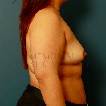 A side view before photo of patient 111 that underwent Breast Augmentation procedures at Memorial Plastic Surgery