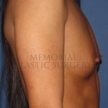 A side view before photo of patient 172 that underwent Breast Augmentation procedures at Memorial Plastic Surgery