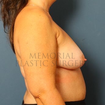 A side view before photo of patient 141 that underwent Breast Augmentation procedures at Memorial Plastic Surgery