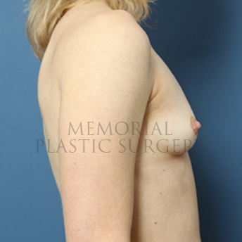 A side view before photo of patient 372 that underwent Breast Augmentation procedures at Memorial Plastic Surgery