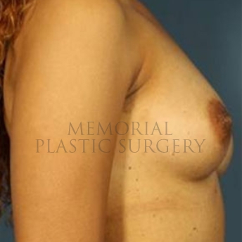 A side view before photo of patient 182 that underwent Breast Augmentation procedures at Memorial Plastic Surgery