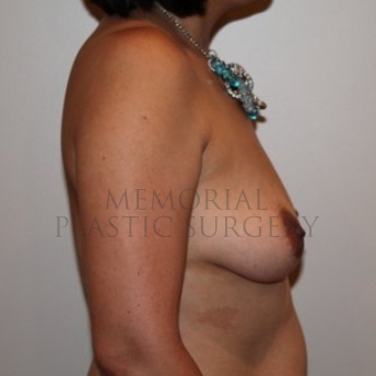 A side view before photo of patient 277 that underwent Breast Augmentation procedures at Memorial Plastic Surgery