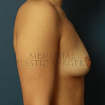 A side view before photo of patient 402 that underwent Breast Augmentation procedures at Memorial Plastic Surgery