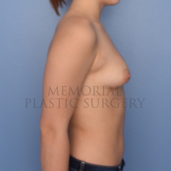 A side view before photo of patient 702 that underwent Breast Augmentation procedures at Memorial Plastic Surgery