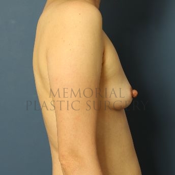 A side view before photo of patient 122 that underwent Breast Augmentation procedures at Memorial Plastic Surgery