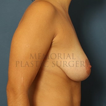A side view before photo of patient 405 that underwent Breast Augmentation procedures at Memorial Plastic Surgery