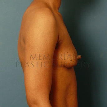 A side view before photo of patient 427 that underwent Breast Augmentation procedures at Memorial Plastic Surgery