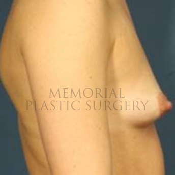 A side view before photo of patient 184 that underwent Breast Augmentation procedures at Memorial Plastic Surgery