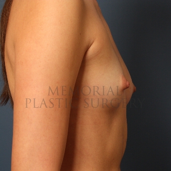 A side view before photo of patient 415 that underwent Breast Augmentation procedures at Memorial Plastic Surgery
