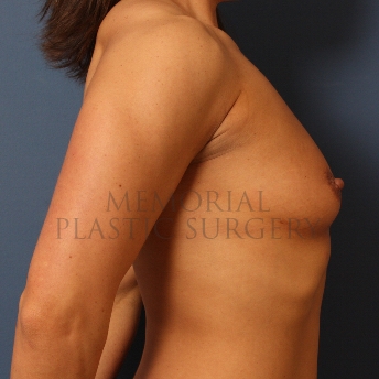 A side view before photo of patient 423 that underwent Breast Augmentation procedures at Memorial Plastic Surgery