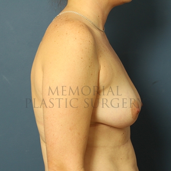 A side view before photo of patient 286 that underwent Breast Augmentation procedures at Memorial Plastic Surgery