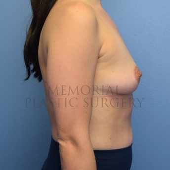 A side view before photo of patient 4101 that underwent Breast Augmentation procedures at Memorial Plastic Surgery