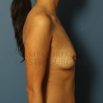 A side view before photo of patient 424 that underwent Breast Augmentation procedures at Memorial Plastic Surgery