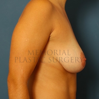 A side view before photo of patient 102 that underwent Breast Augmentation procedures at Memorial Plastic Surgery