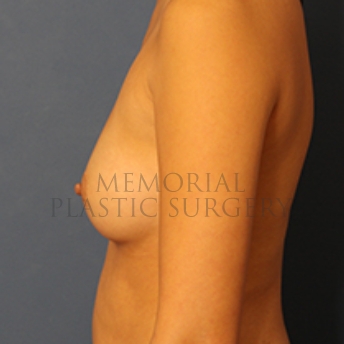A side view before photo of patient 398 that underwent Breast Augmentation procedures at Memorial Plastic Surgery