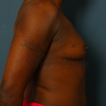 A side view before photo of patient 77 that underwent Breast Augmentation procedures at Memorial Plastic Surgery