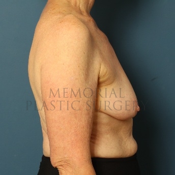 A side view before photo of patient 72 that underwent Breast Augmentation procedures at Memorial Plastic Surgery