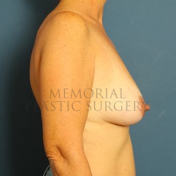 A side view before photo of patient 140 that underwent Breast Augmentation procedures at Memorial Plastic Surgery