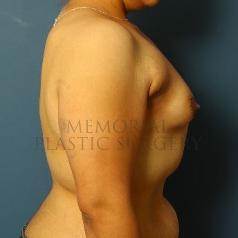 A side view before photo of patient 137 that underwent Breast Augmentation procedures at Memorial Plastic Surgery