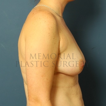 A side view before photo of patient 60 that underwent Breast Augmentation procedures at Memorial Plastic Surgery