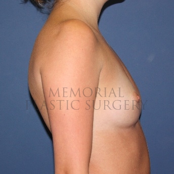 A side view before photo of patient 94 that underwent Breast Augmentation procedures at Memorial Plastic Surgery