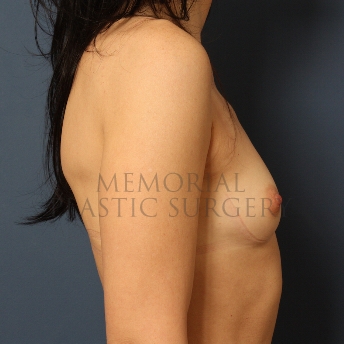 A side view before photo of patient 406 that underwent Breast Augmentation procedures at Memorial Plastic Surgery