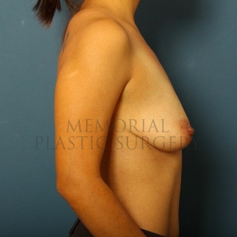 A side view before photo of patient 115 that underwent Breast Augmentation procedures at Memorial Plastic Surgery