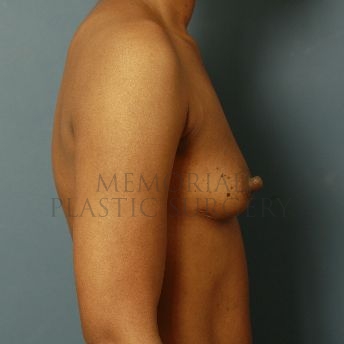 A side view before photo of patient 133 that underwent Breast Augmentation procedures at Memorial Plastic Surgery