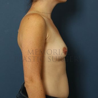 A side view before photo of patient 147 that underwent Breast Augmentation procedures at Memorial Plastic Surgery