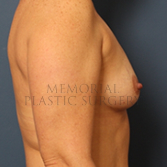 A side view before photo of patient 352 that underwent Breast Augmentation procedures at Memorial Plastic Surgery