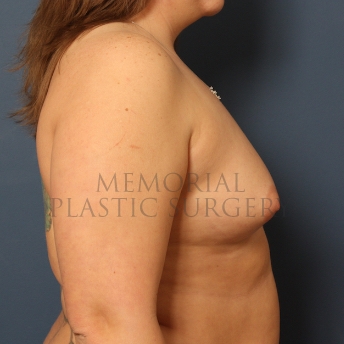 A side view before photo of patient 467 that underwent Breast Augmentation procedures at Memorial Plastic Surgery