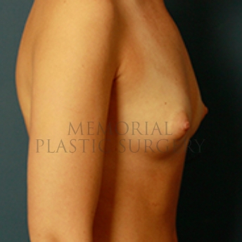 A side view before photo of patient 378 that underwent Breast Augmentation procedures at Memorial Plastic Surgery