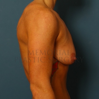 A side view before photo of patient 75 that underwent Breast Augmentation procedures at Memorial Plastic Surgery