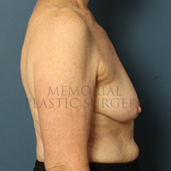 A side view before photo of patient 332 that underwent Breast Augmentation procedures at Memorial Plastic Surgery