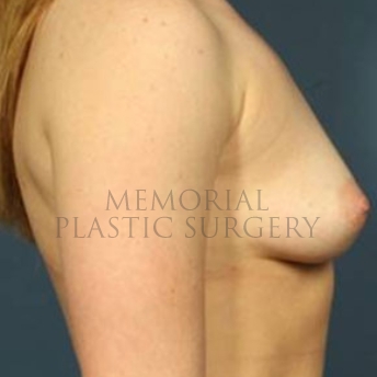 A side view before photo of patient 171 that underwent Breast Augmentation procedures at Memorial Plastic Surgery
