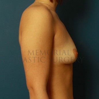 A side view before photo of patient 101 that underwent Breast Augmentation procedures at Memorial Plastic Surgery