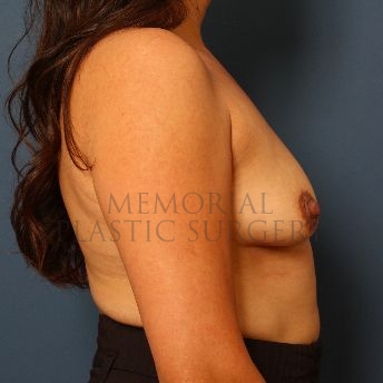 A side view before photo of patient 145 that underwent Breast Augmentation procedures at Memorial Plastic Surgery