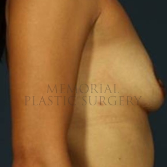 A side view before photo of patient 179 that underwent Breast Augmentation procedures at Memorial Plastic Surgery