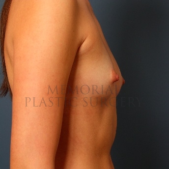 A side view before photo of patient 110 that underwent Breast Augmentation procedures at Memorial Plastic Surgery