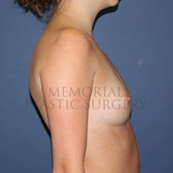A side view before photo of patient 385 that underwent Breast Augmentation procedures at Memorial Plastic Surgery